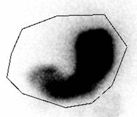 Pick the Best Test to Assess Gastric Emptying