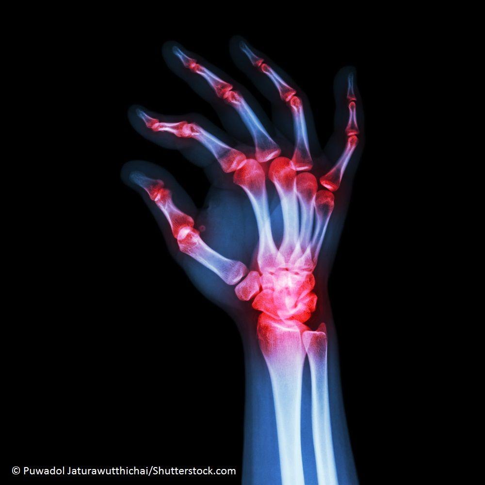 Filgotinib With Methotrexate for Rheumatoid Arthritis