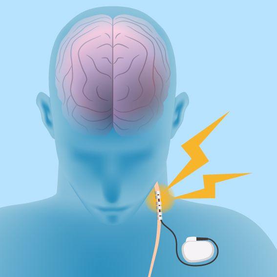 (Vagus nerve stimulation ©Chombosan/Shutterstock.com)