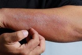 Biologics for Inflammatory Skin Disease Accepted During COVID-19 Pandemic