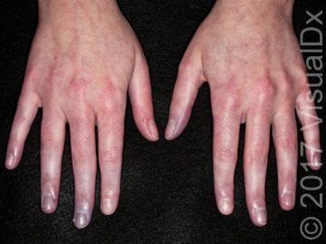 Four Skin Conditions Associated with Rheumatic Disease