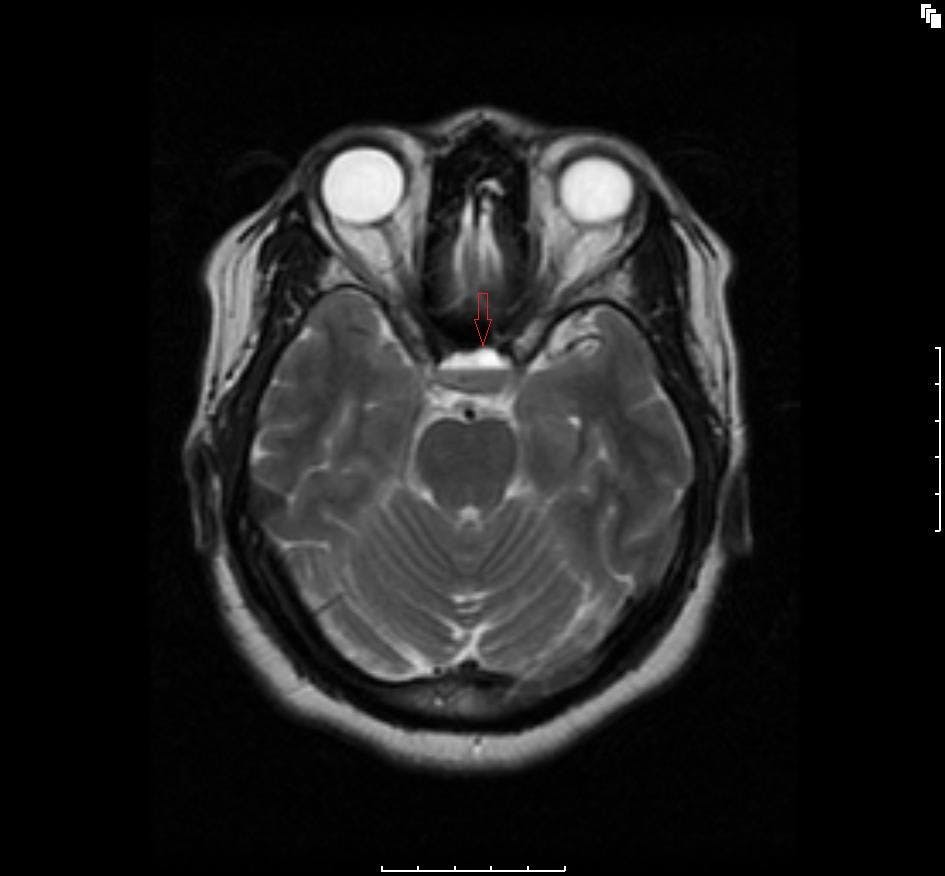 Hemorrhagic Pituitary Apoplexy in Pregnancy: What's True? 