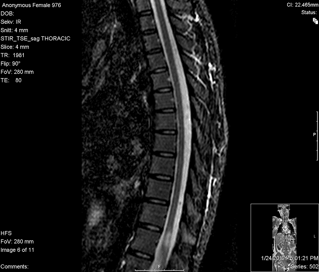 AQP4-Ab was positive for Neuromyelitis Optica (Devic’s disease), a rare inflamma