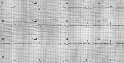 ECG reading