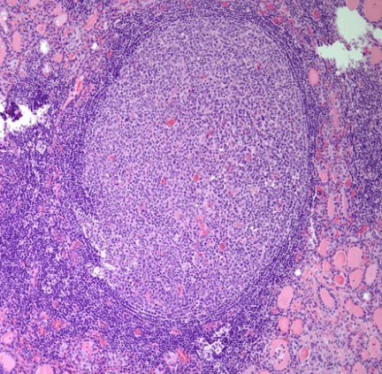 germinal center papillary thyroid cancer