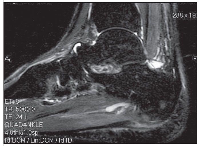 Foot Pain After Parkour in a 31-Year-Old Man