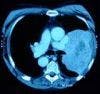 CT Scans Increase Patients' Risk of Cancer