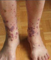 small-vessel vasculitis