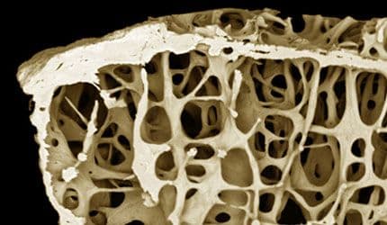 Osteoporosis Pharmacotherapy Use Falls Short