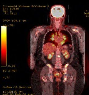 Woman With Sarcoidosis, Lymphoma, and Shoulder Pain