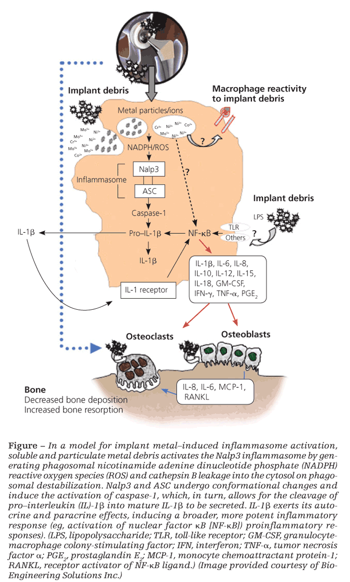 Inflammatory bone loss in joint replacements: The key mediators