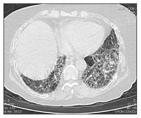 Lung Disease in Scleroderma, Part I: Ten Points About ILD