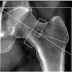 Post-Bisphosphonate DXA Monitoring Unrelated to Fracture Risk