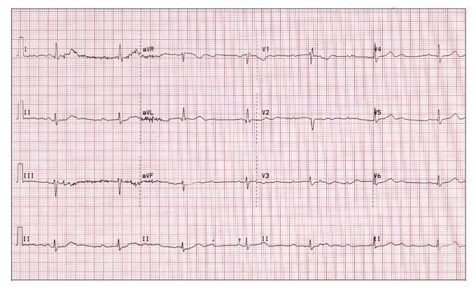 Remission, TNF Blockers Cut Heart Failure Risk in RA