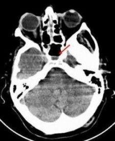 Rhinocerebral Mucormycosis in Woman with Uncontrolled Diabetes