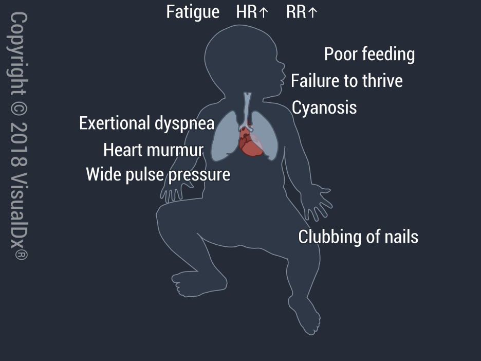 Image IQ: Newborn with Increased Fatigue and a Heart Murmur