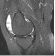 pigmented villonodular synovitis